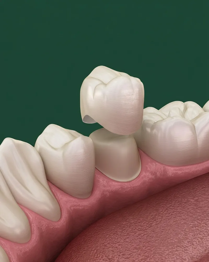 Dental-Crown Dental Crown