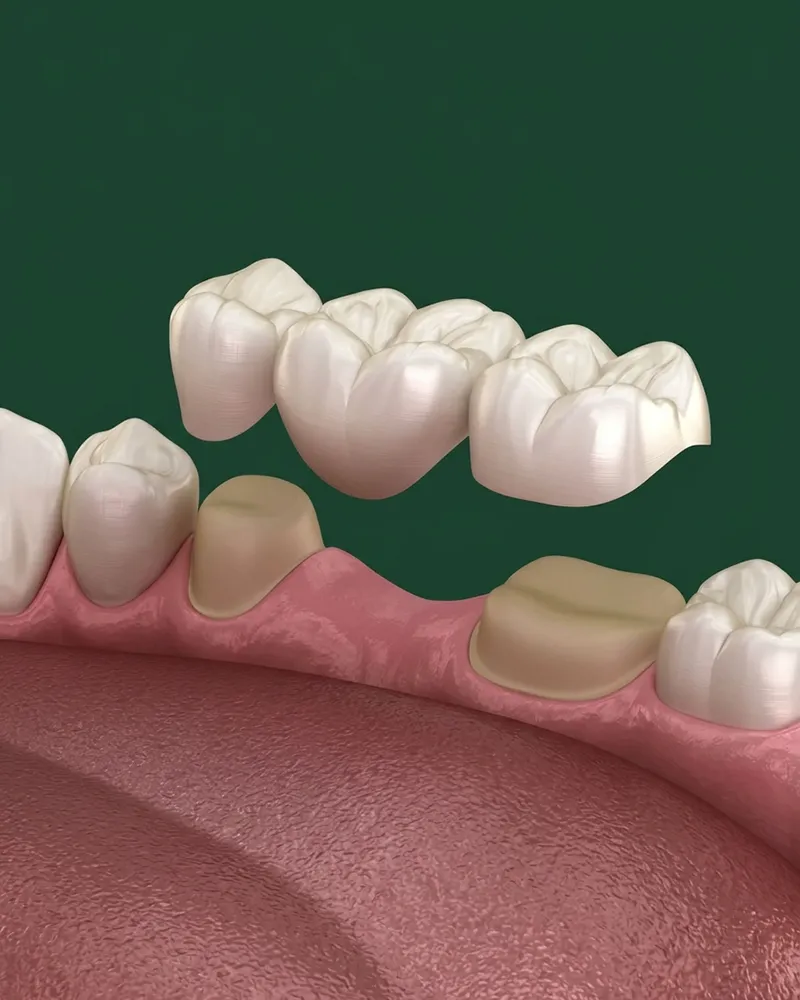 Dental-bridges Dental bridge