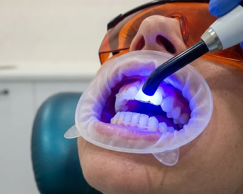 Teeth Whitening
