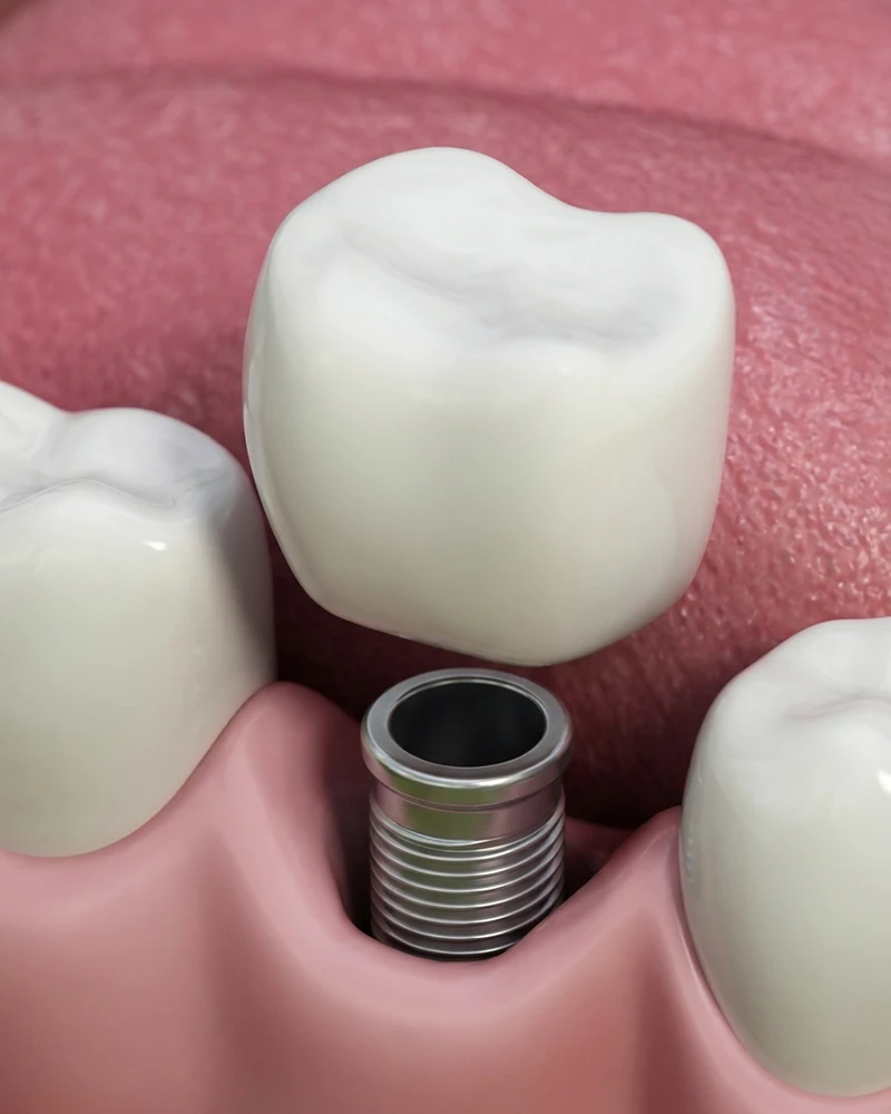 Dental-implant-screw Dental Implant Patient
